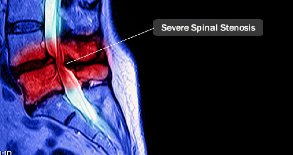 WebMD's tweet photo. Spinal stenosis is most common in men and women over 50 years old. What to know about the condition: https://t.co/WOaw8eBBFx https://t.co/Ui18NQqxMr