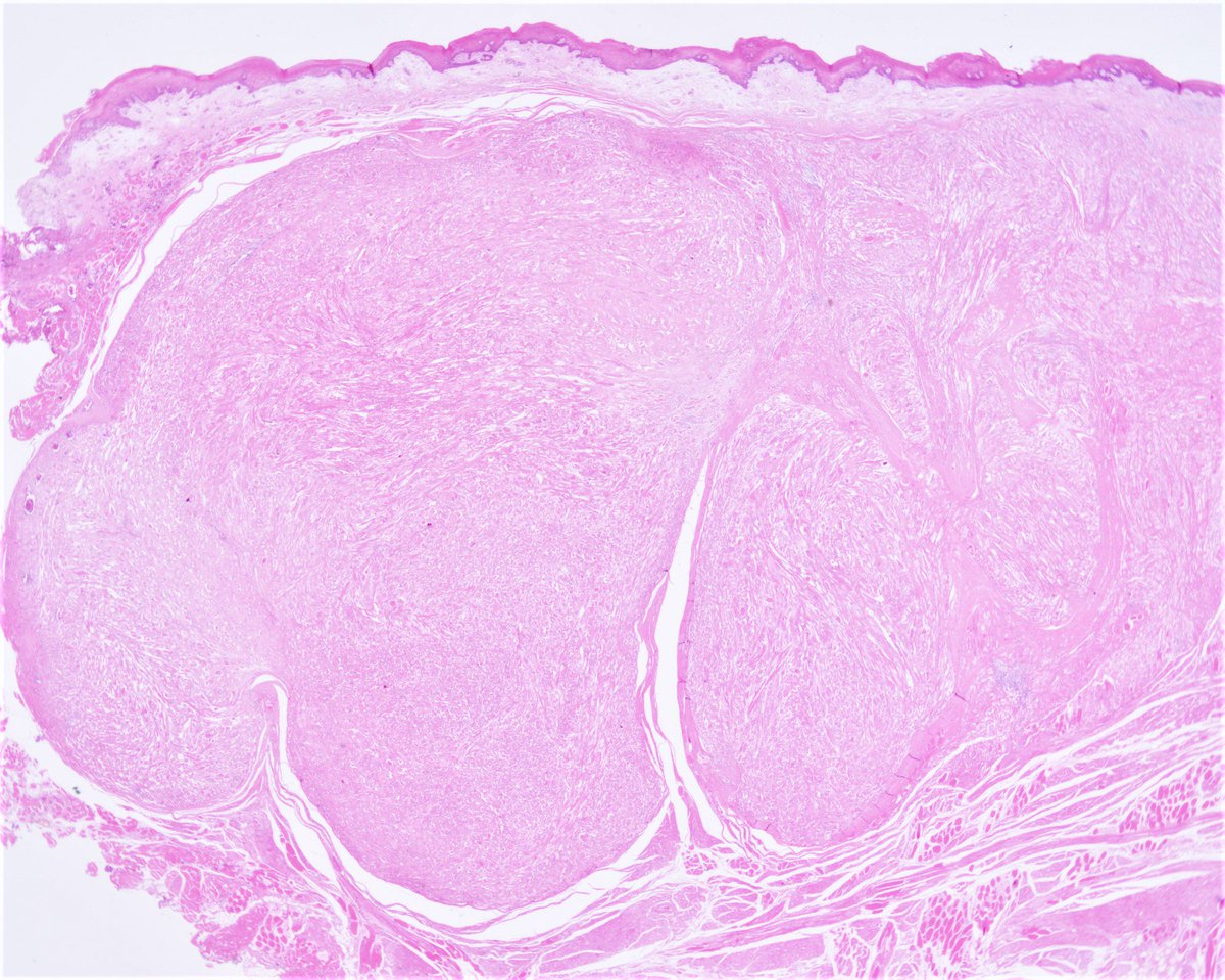 Patholwalker's tweet photo. Rhabdomyoma of the tongue. Tongue, partial glossectomy. HE stain. https://t.co/SeQ5ghnH4H