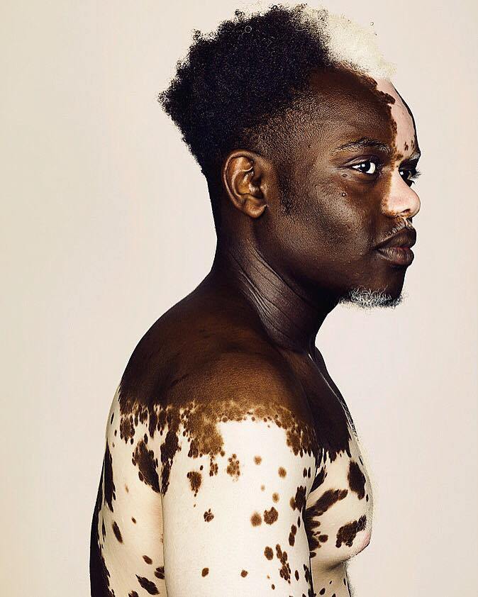 EliChep's tweet photo. Model Bashir Aziz on finding beauty in difference &amp; now modelling his Vitiligo to the… https://t.co/2RnVsRptK6 https://t.co/SvIRSwTd09