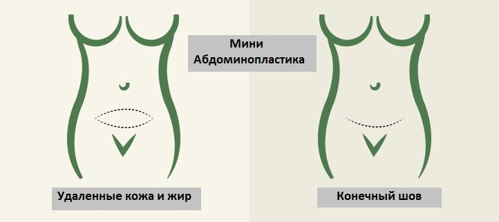 Липосакция или абдоминопластика? Или все вместе? Существует несколько хирургических операций, с помощью которых можно значительно улучшить вид живота.
#живот #липосакция #абдоминопластика #пластическая_операция #красота 

goo.gl/MYZ8ZW