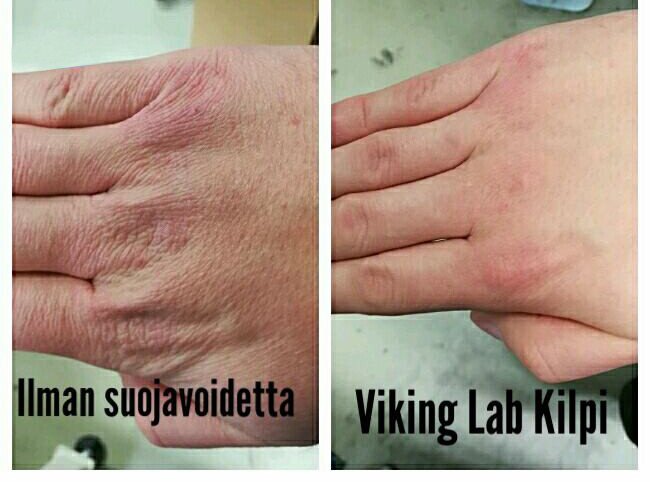 Viking Lab Kilpi tuote kerää paljon hyvää palautetta 🙂
Asiakaspalaute: Ilman Kilpi suojavoidetta käsien iho ärtynyt, kuiva ja kutiseva kuten kuvasta näkyy. Viking Lab Kilpi suojavoiteen aloittamisen jälkeen käsien iho rauhoittui #suomi #suomi100 #laatua #yrittäjät #Tampere