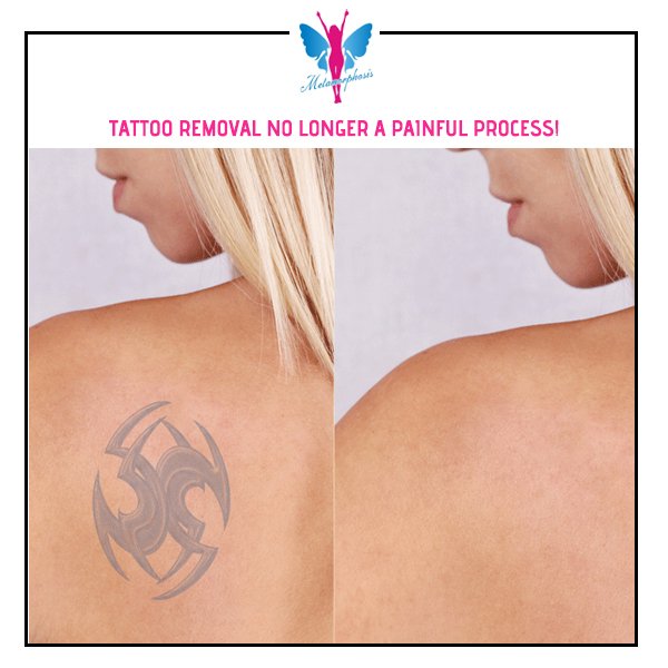 Tattoo Removal WIth Pico Laser  Tattoo Removal Greece