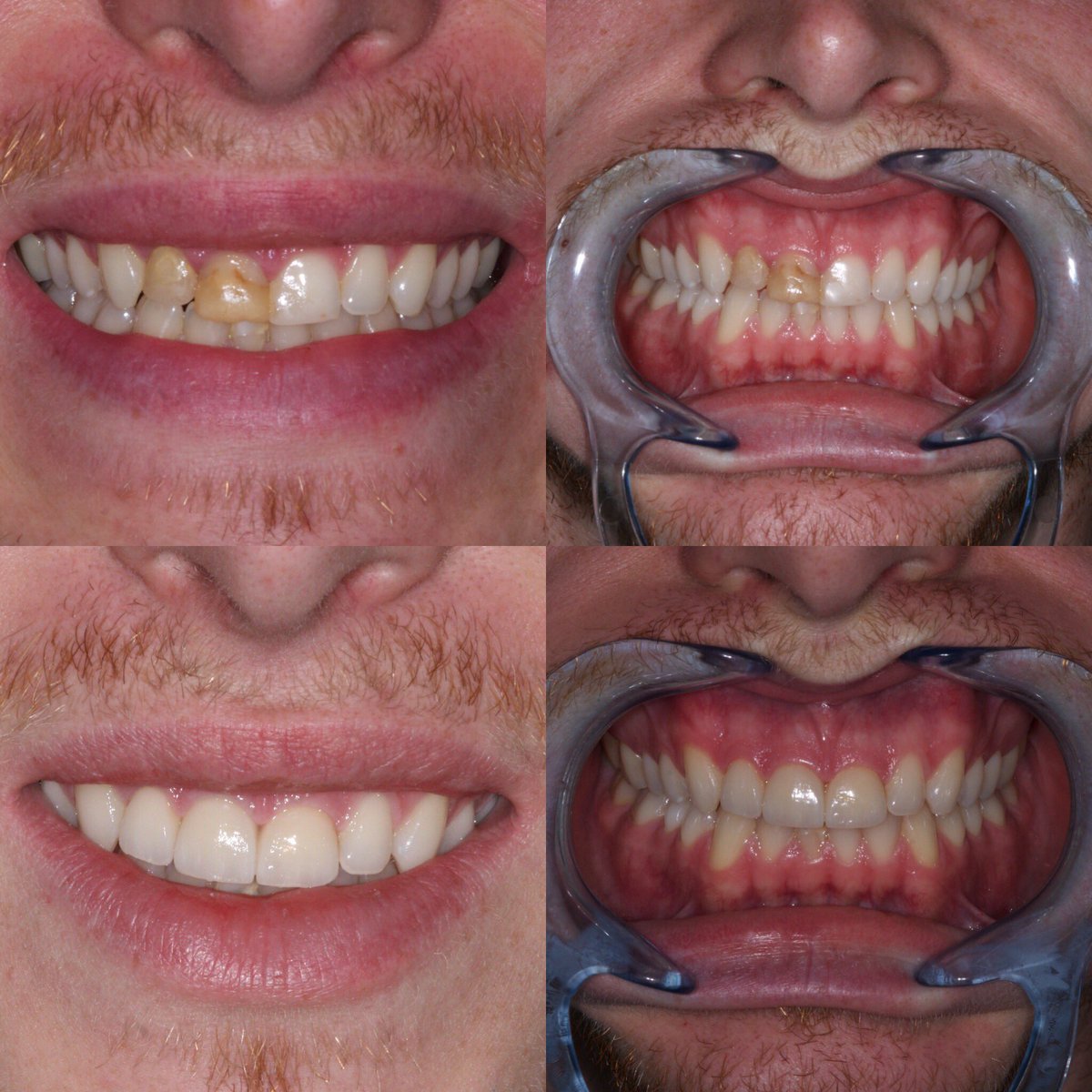 Smile makeover by <a href="/DrSatyaPatel/">Satya</a> #smilewithconfidence #penrith #cumbria #stricklandgatedental #strictlydental #emax #Smile #cosmeticdentistry @IvoclarUK <a href="/NotJustLakes/">Not Just Lakes</a>