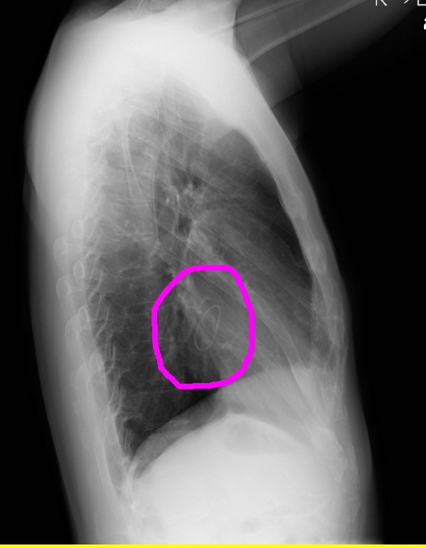 O Xrhsths きのした先生 とんぺてぃーず Sto Twitter やっぱりジョジョ芸人を名乗るくらいなら心臓にリングくらいはめとかないとね レントゲンの画像いただいてきました