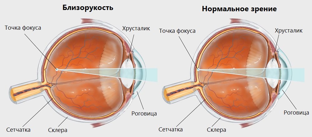 Нормальное зрение и зрение при близорукости