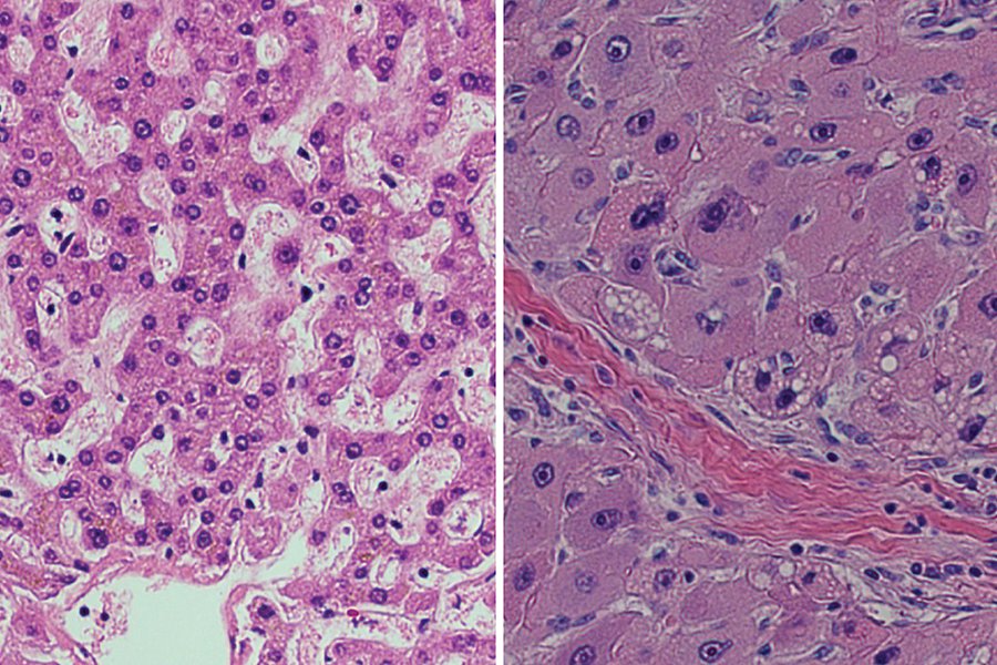 TCRT_Cancer's tweet photo. New study points the way to therapy for rare #cancer that targets the young https://t.co/3YNaHdGwE7 @rockefelleruniv #livercancer #cancerbiology #FLHCC #cancertreatment https://t.co/YwlhB13d7p
