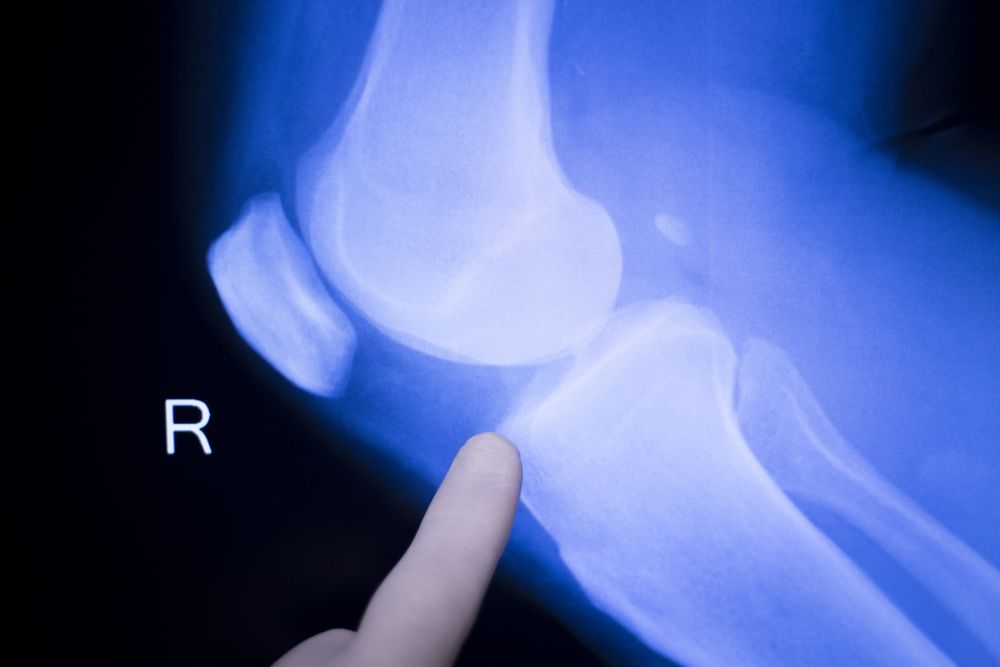 DrNikhilVerma's tweet photo. The #PCL can be torn in isolation or in conjunction with the other major ligaments. A mild tear can typically heal on its own, but severe tears will require a #PCLsurgery to reconstruct the ligament https://t.co/tJ3ivvoBj4 https://t.co/IH09HzJ5pt