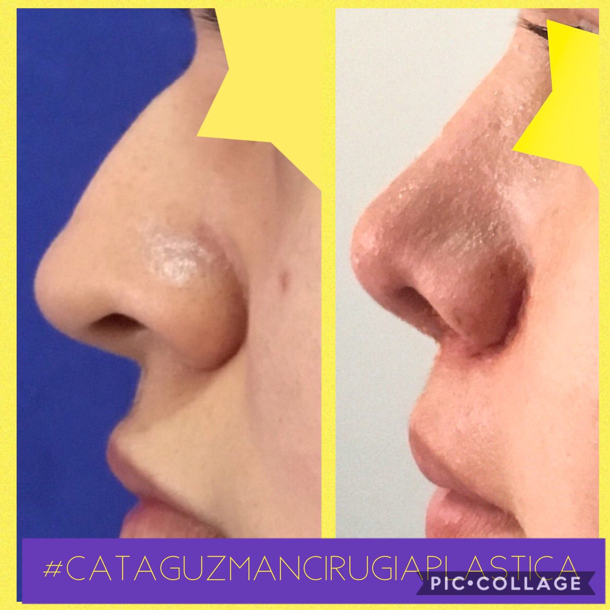 CxPlasticaCGD's tweet photo. La mejor rinoplastia es la que no se nota. ¿Buscas resultados naturales? Búscame a mi. 
Contacto: 6164793 en Bogotá, 3044743071 en Villavicencio.
Email catamd50@hotmail.com
#NoseJob 
#RinoplastiaBogota #RinoplastiaColombia #RinoplastiaVillavicencio #cataguzmancirugiaplastica https://t.co/GFWuAXT1KA