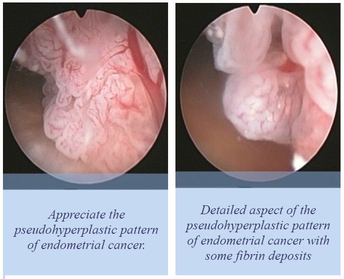 Can Endometriosis Cause Vaginal Discharge?