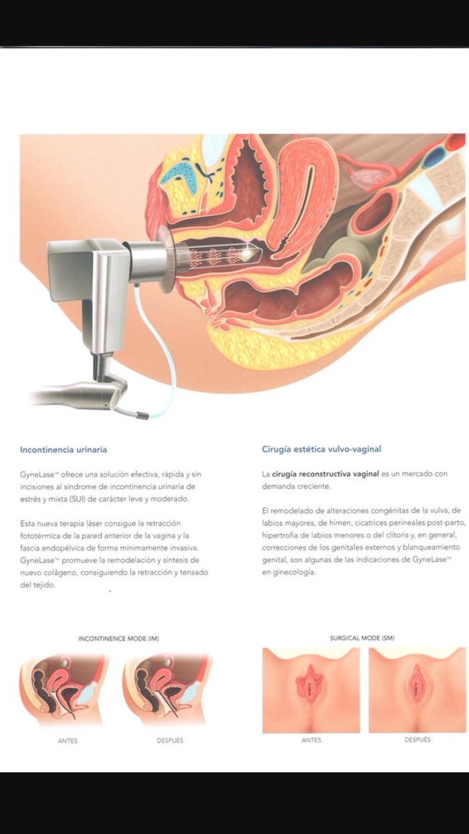 Espectacular tratamiento ambulatorio de la incontinencia urinaria femenina, atrofia vulvivaginal, vph persistente,condolimas, ninfoplastia, liquen vulvar...