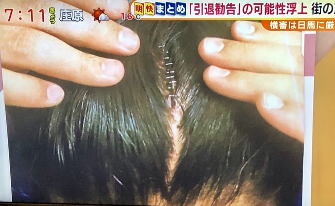 貴ノ岩の頭部が割れホッチキスで9針の大怪我 まとめダネ 貴ノ岩の頭部が割れホッチキスで9針の大怪我 まとめダネ
