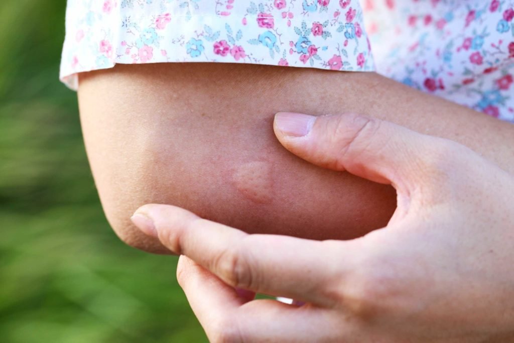 longrayfog's tweet photo. Bitten by #Bugs? Here’s what happens to your body when you get a #BugBite—and why you shouldn’t scratch it - Click to see!
https://t.co/yXfrS3ejIB https://t.co/ivGr46EB8B