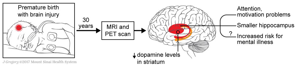 KingsIoPPN's tweet photo. Complications at birth associated with lasting chemical changes in the brain - new @eLife paper from @PretermResearch: https://t.co/VB7mkxsLLo https://t.co/Agdfz1yd2B
