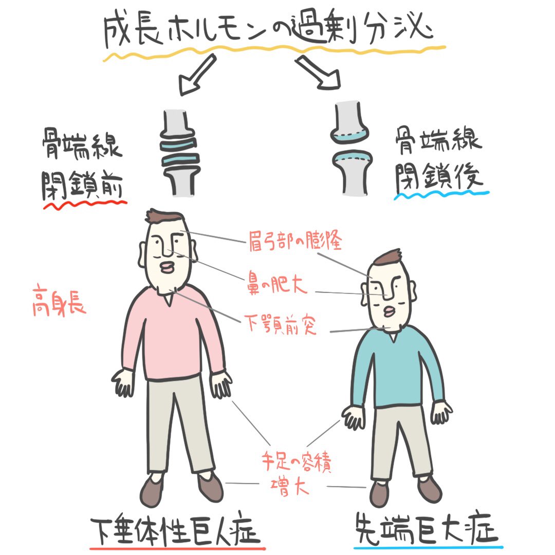 ゴロ 解剖生理イラスト בטוויטר パッと見で分かる 下垂体性巨人症 と 先端巨大症 骨端線閉鎖前か後がカギを握っている ゴロ 解剖生理イラスト בטוויטר パッと見で分かる 下垂体性巨人症 と 先端巨大症 骨端線閉鎖前か後がカギを握っている