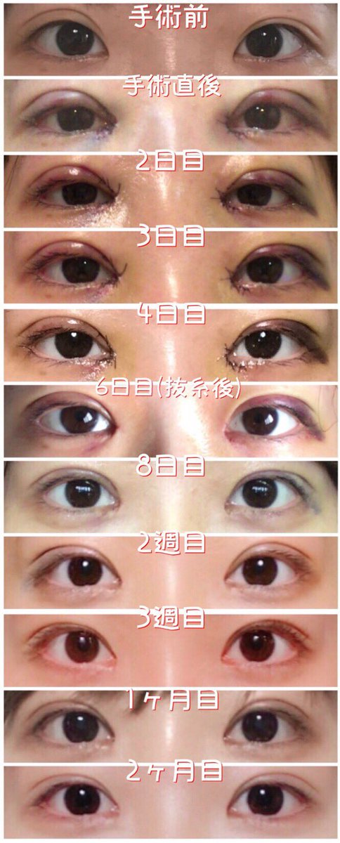 あお Twitterissa 遅くなってしまいましたがエイペッ スで目頭切開 非切開目つき矯正の経過 1枚目 と現在との比較写真 2枚目 です 場所などバラバラですみません こうして見ると本当にやってよかった