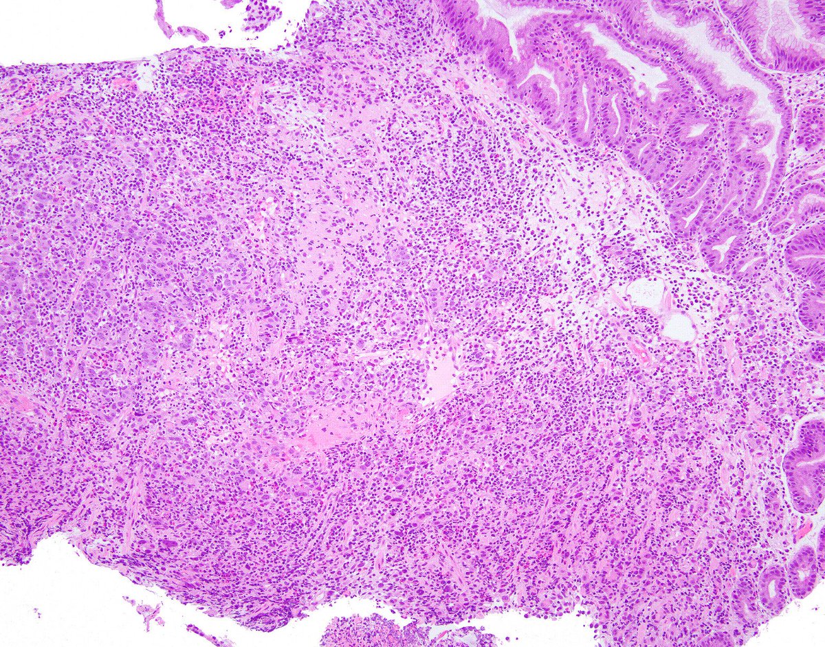 science_press's tweet photo. This gastric lymphoepithelioma-like carcinoma has prominent intratumoral lymphocytes and positive Epstein Barr virus in situ hybridization.  https://t.co/VWopNi6JvQ https://t.co/Py0O7ybVVj