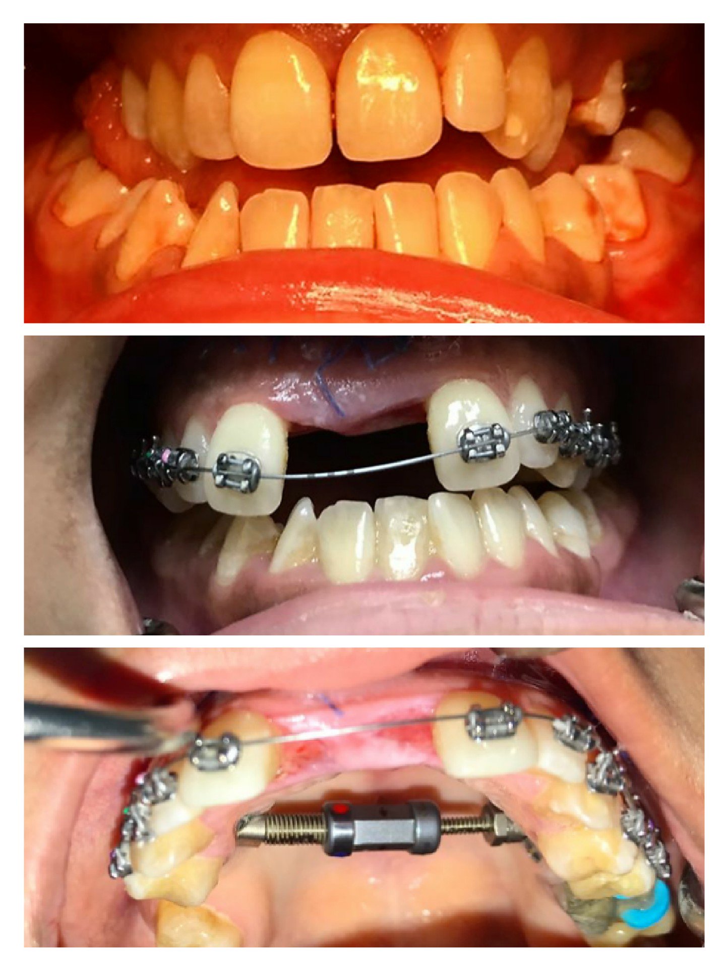 د بيشي القرني Twitter ನಲ ಲ عمليه لتوسيع الفك العلوي باستخدام الاستطاله العظميه Distraction Osteogensis و التمكن من ايجاد مسافه كافيه بين الاسنان الاماميه تكفي لتحريك الاسنان فيها و توسيع الفك العلوي ومن ثم