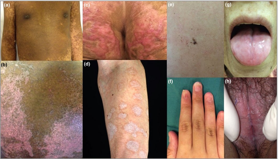 Long-term complications of Stevens–Johnson syndrome/toxic epidermal necrolysis (SJS/TEN): the spectrum of chronic problems in patients who survive an episode of SJS/TEN necessitates multidisciplinary follow-up (£) goo.gl/zVU852