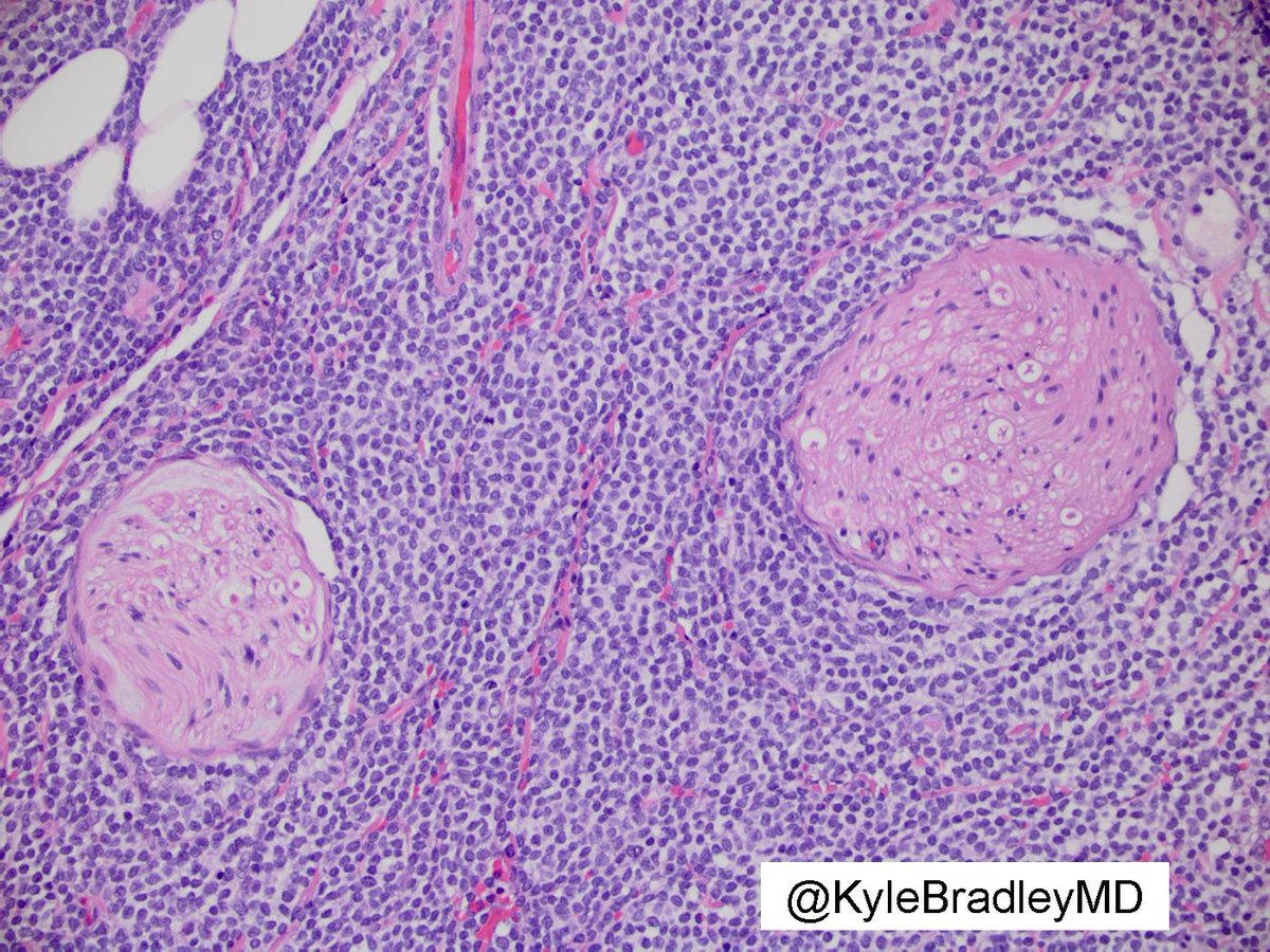 KyleBradleyMD's tweet photo. Mantle cell lymphoma wrapping around nerves. (Periparotid tissue) https://t.co/QgjBEf8XTo