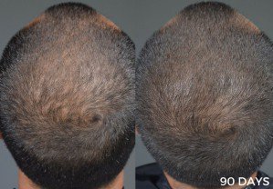 EncinitasDirect's tweet image. #Photo: #Encinitas hair loss from Healthy Hair Nectar - bit.ly/2j0Kx3c