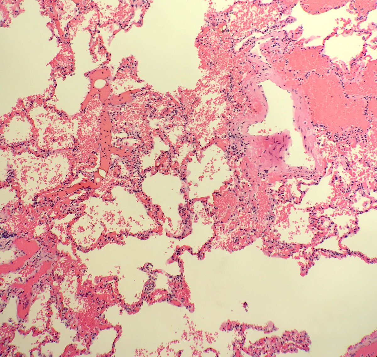 seattlequinns's tweet image. Fall from height: blunt force injuries including pulmonary contusions: interstitial and alveolar hemorrhage, damaged bronchioles and vessels with hemorrhage in the walls. Fat emboli can be seen (femoral shaft fracture x 2) #pulmonarypath #lungpath #forensics #forensicpath
