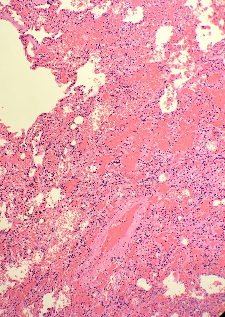 seattlequinns's tweet image. Fall from height: blunt force injuries including pulmonary contusions: interstitial and alveolar hemorrhage, damaged bronchioles and vessels with hemorrhage in the walls. Fat emboli can be seen (femoral shaft fracture x 2) #pulmonarypath #lungpath #forensics #forensicpath