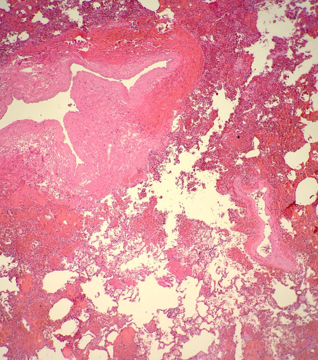 seattlequinns's tweet image. Fall from height: blunt force injuries including pulmonary contusions: interstitial and alveolar hemorrhage, damaged bronchioles and vessels with hemorrhage in the walls. Fat emboli can be seen (femoral shaft fracture x 2) #pulmonarypath #lungpath #forensics #forensicpath