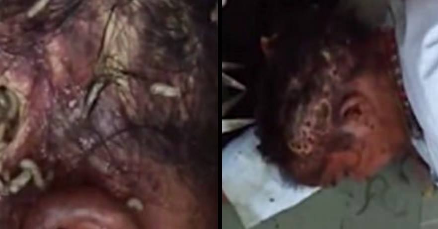 LADbible on X: Homeless woman with head infected by maggots is