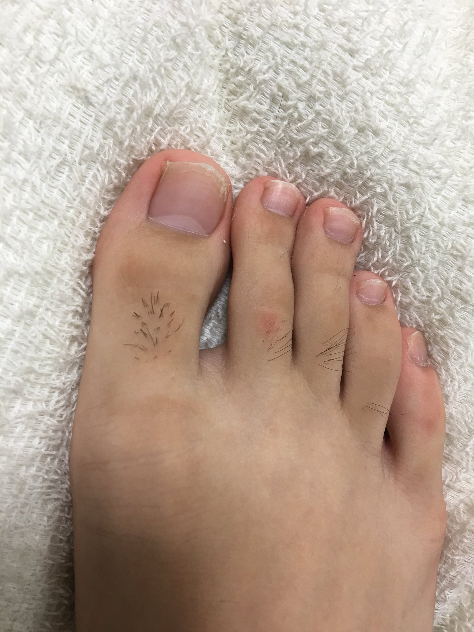 Twitter 上的 はやし なおき 自慢の足の指毛をカットされてしまいました T Co Alx528zd3z Twitter