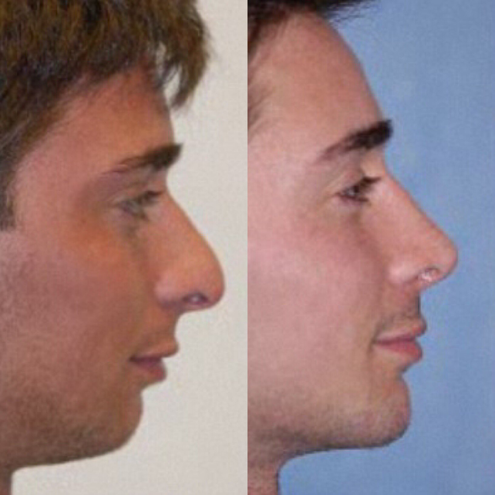 cheekbone implants men before and after