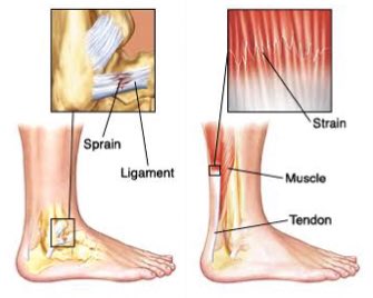 Image result for sprain vs strain