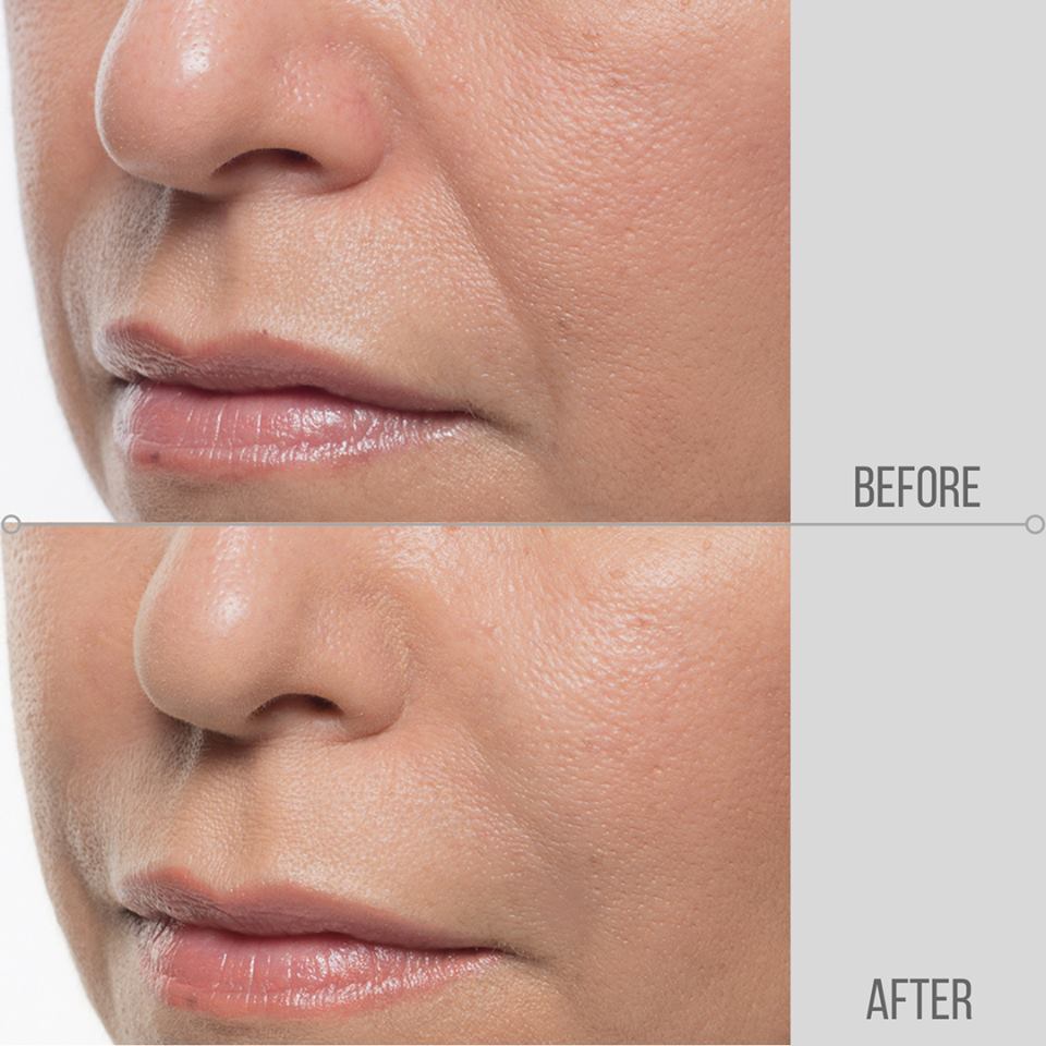 midwestaging's tweet image. Smile lines got you feeling down? Unlike other dermal fillers, #Bellafill creates results that last. 
Call ☎️ us at: (815)277-5229
#dermalfillers #MedSpa #aesthetics