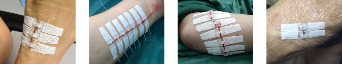 DermaClip's tweet image. Get latest news and information on the most advanced #skin_closure_device, coupled with huge discount on your first order. Subscribe to the DermaClip® newsletter and avail attractive 20% discount on your first order!dermaclipus.com