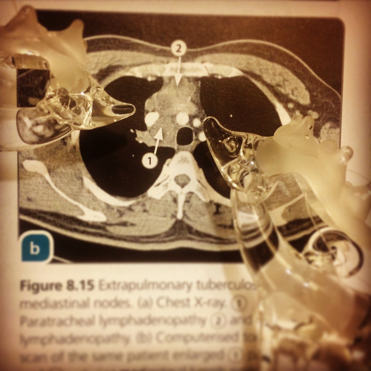 RespTrainees's tweet photo. On the twelfth day of #Respmas my true love gave to me twelve lymph nodes necrosing! #TB #Respisbest https://t.co/WojLZO2ZuC