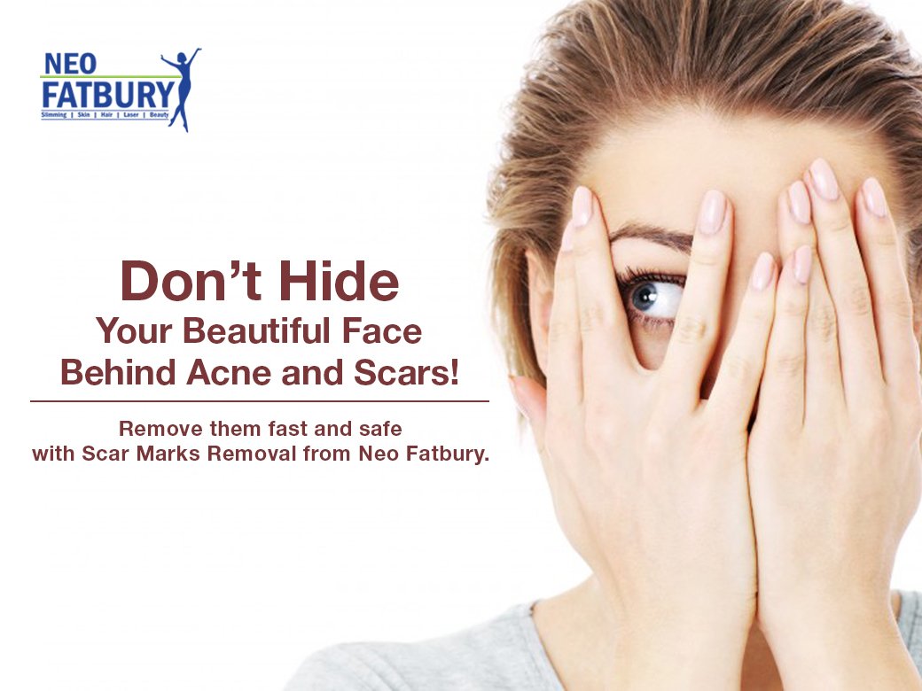 Worried about the acne marks and scars on your face? Now you can also flaunt your smooth and shiny skin with Scar Marks Removal Treatment from Neo Fatbury. 
#NeoFatbury #ScarMarksRemoval #HealthySkinHealthyYou