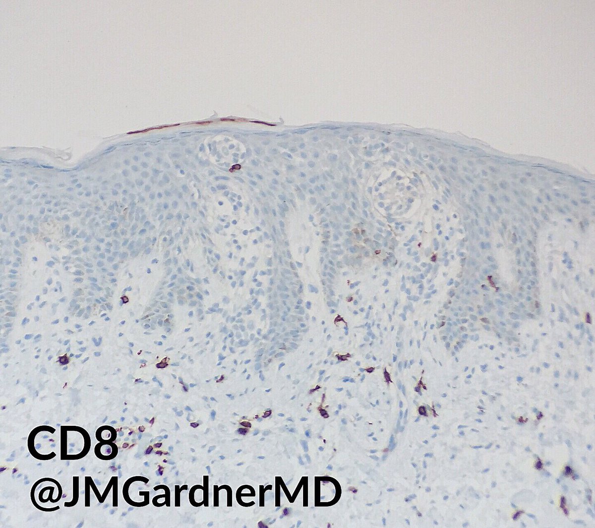 Classic IHC for mycosis fungoides. CD4+/CD3+ T-cells clustered into intraepidermal Pautrier microabscesses. See those scattered CD4+/CD3- cells in epidermis? Those are normal Langerhans cells. Don’t use CD4 alone for MF. #dermpath #Pathology #dermatology #hemepath