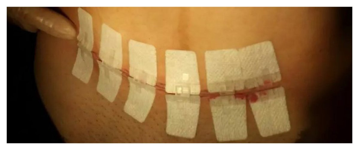 DermaClip's tweet image. Efficient, quick #wound_closure with enhanced patient care! DermaClip® non-invasive skin closure device is suitable even for patients with fragile skin!dermaclipus.com