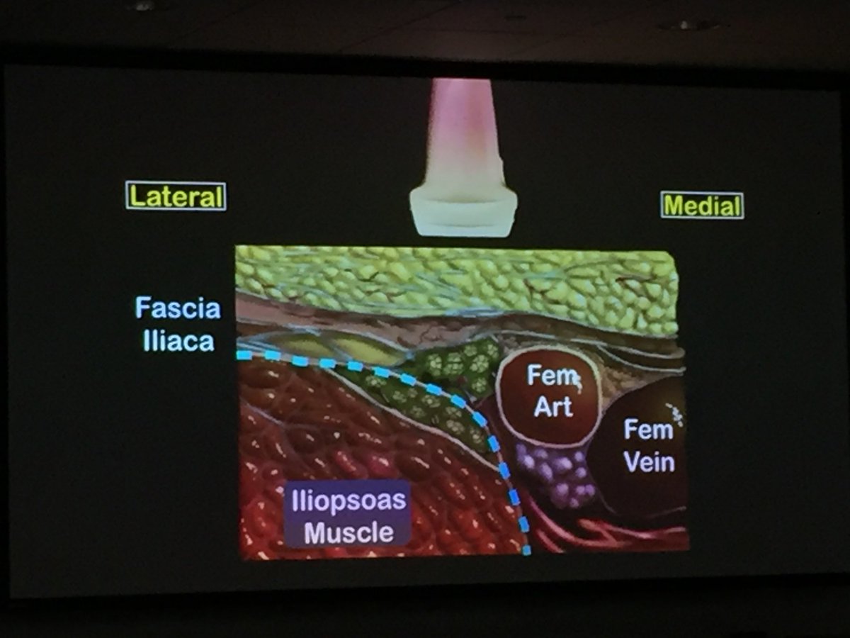 VivetaLobo's tweet photo. “It’s more important to recognize a fascial plane than identifying the nerve” Pearls from the US guided nerve block guru @NagdevArun at our @StanfordEMRes #POCUS conference today. #FOAMus #FOAMed https://t.co/bdd3jUMfQX