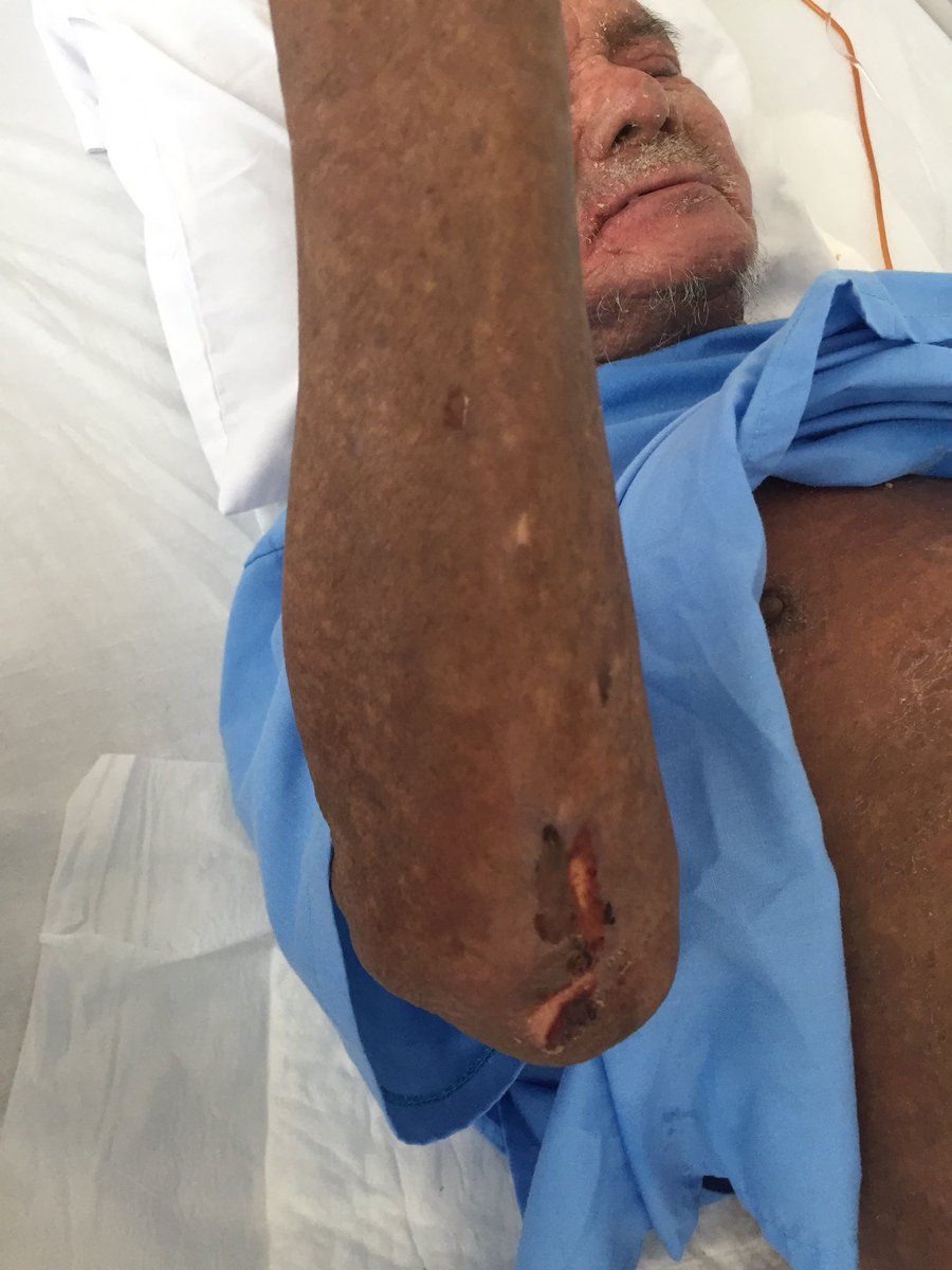 Respuesta: Pénfigo superficial (foliáceo). El pénfigo superficial es una enfermedad ampollosa autoinmune que se caracteriza por una separación de las células de la piel causada por anticuerpos. Esta variedad rara vez muestra ampollas, solo muestra descamación y enrojecimiento.