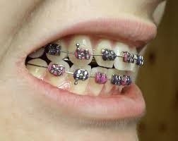 PrairieHawkDent's tweet image. Check out this list of orthodontic options. Contact us to see which is best for you! goo.gl/DhV081