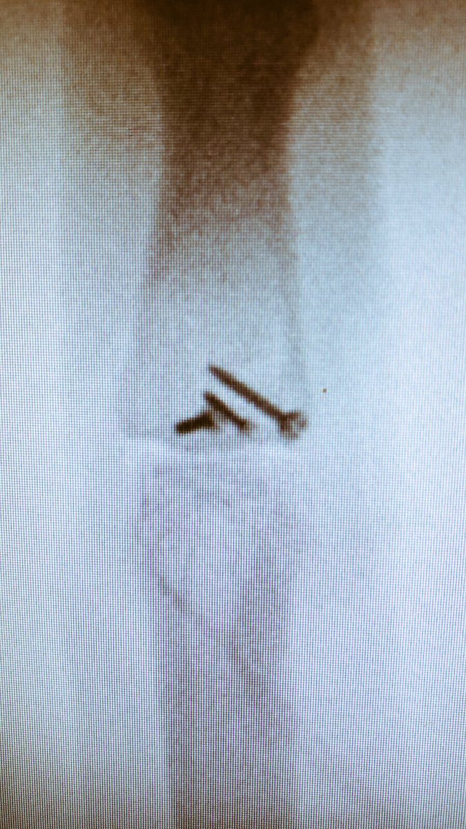 Westley21's tweet photo. Gutted I had to leave the @englandcricket lions.. best of luck to the boys! Operation ✅, on the mend, a few additions to middle finger #🖕🏻 https://t.co/zbwLBG9LFM