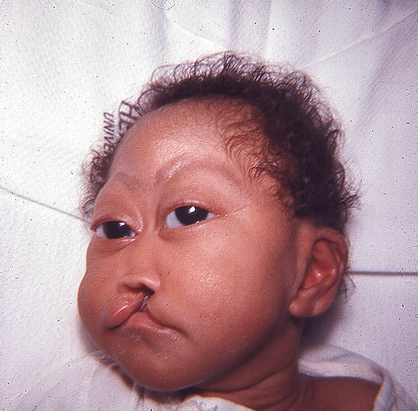Syndrome patau