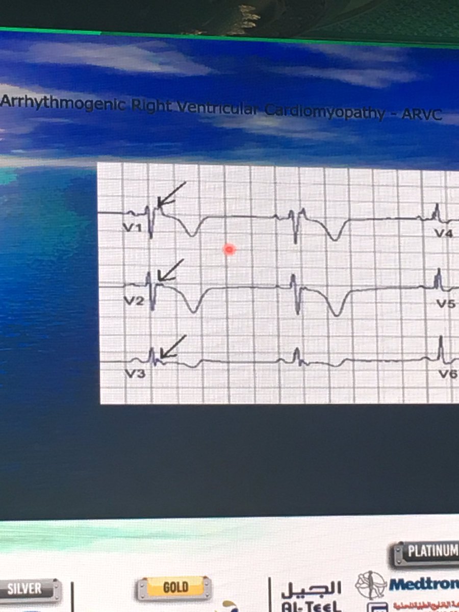 Epsilon wave major criteria for  ARVC /ECG course DR Fayez Bokhari  #KFAFH16