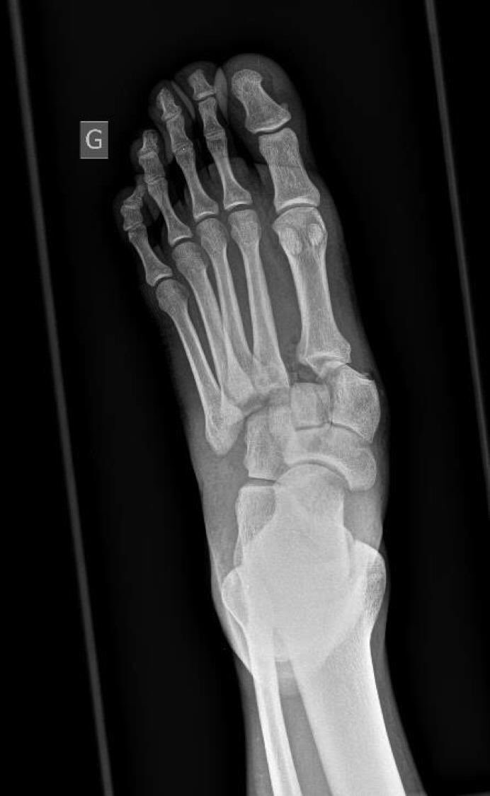 WilleminYves's tweet photo. An example of purely #ligamentous injuries of #Lisfranc
@orthobullets @AOFAS @BOFAS_UK 
https://t.co/51U4cLKrbA https://t.co/9EWSz9yyJG