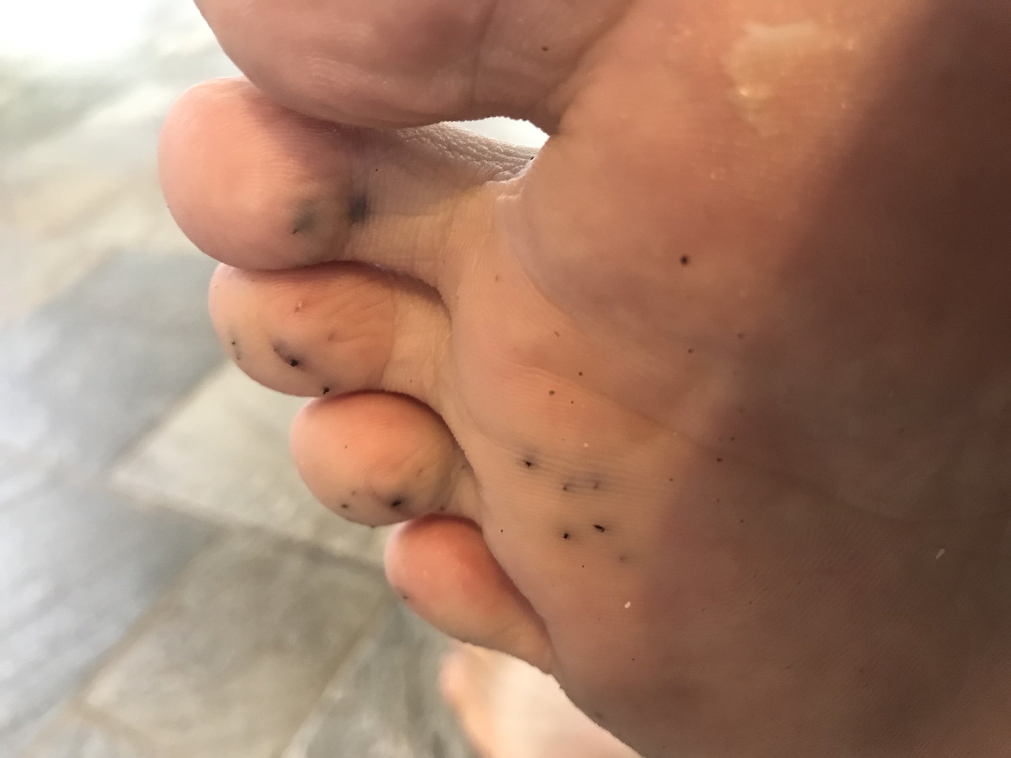 psalm on X: "sea urchin in my foot yow!!!! https://t.co/N6NZtOYgFK" / X