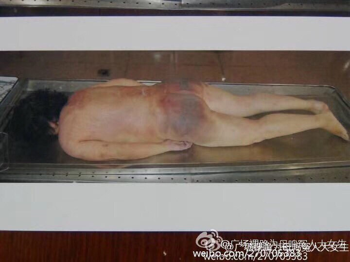 ningli21's tweet image. 昨天接到蓬莱检察院的电话，四官员案已经侦查完毕转到审查起诉了，可以阅卷了。我告了八年，上访了八年，被打压，威胁了八年，这些凶手逍遥法外了八年，拿了8年的工资。尚德松还当了八年的龙口市宣传部副部长。杀了人，他们会忘记8年前如何打死我妈妈的细节么？明天就能阅到卷了，不会口供都记不清了？