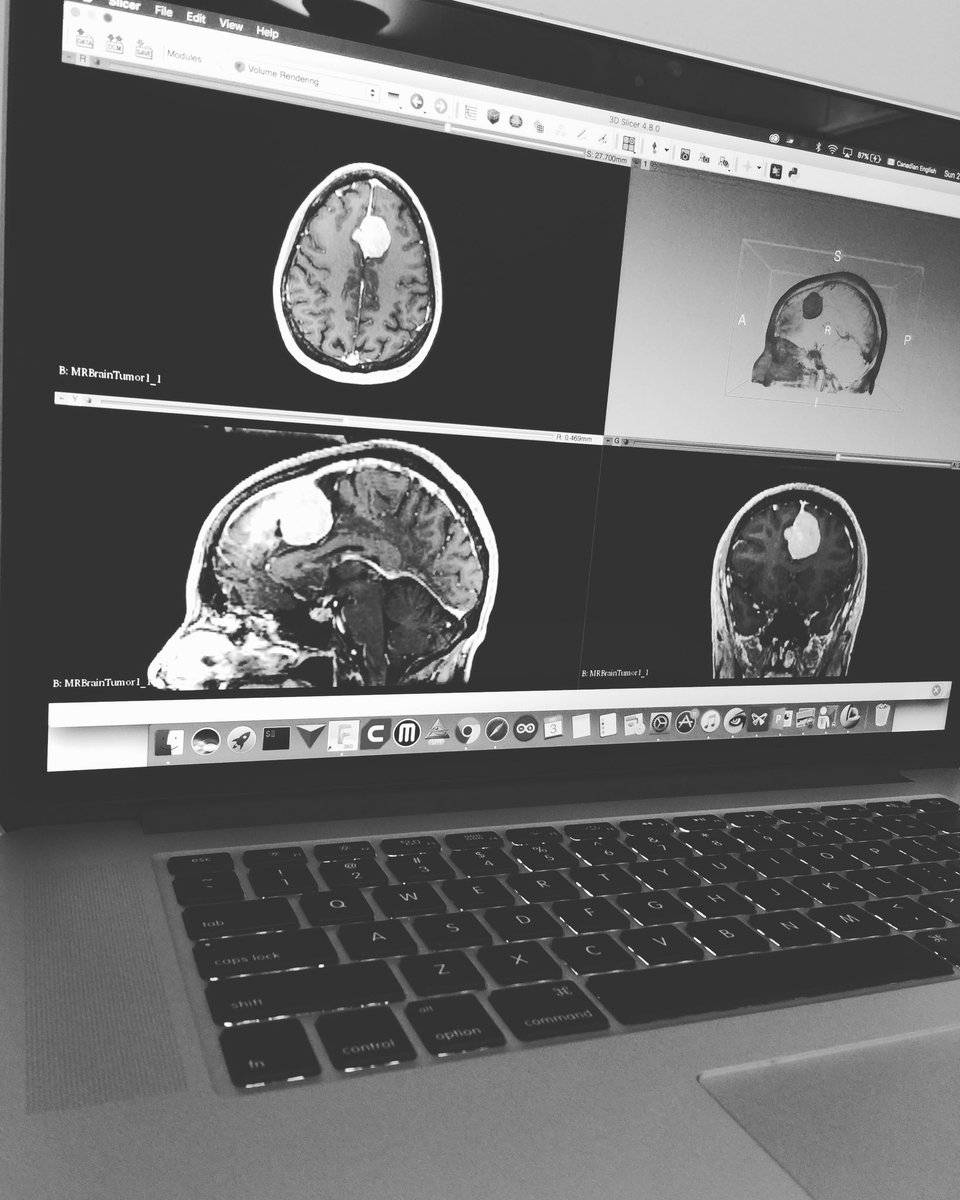 اكملت ١٨ ساعة 😞
نفس الكرسي! نفس المكان! 
أعمل على تجهيز مجسم 3D لورم 
للجنة التخطيط الجراحي، بصراحة 
الي ما خلاني أقوم من مكاني شي واحد 
كل ما راودتني نفسي للتوقف، تخيلت شعور وفرحت الشخص وقد شفي .. فأستمر 🤗

ضع هدفك نصب عينيك دوماً 👌🏼
