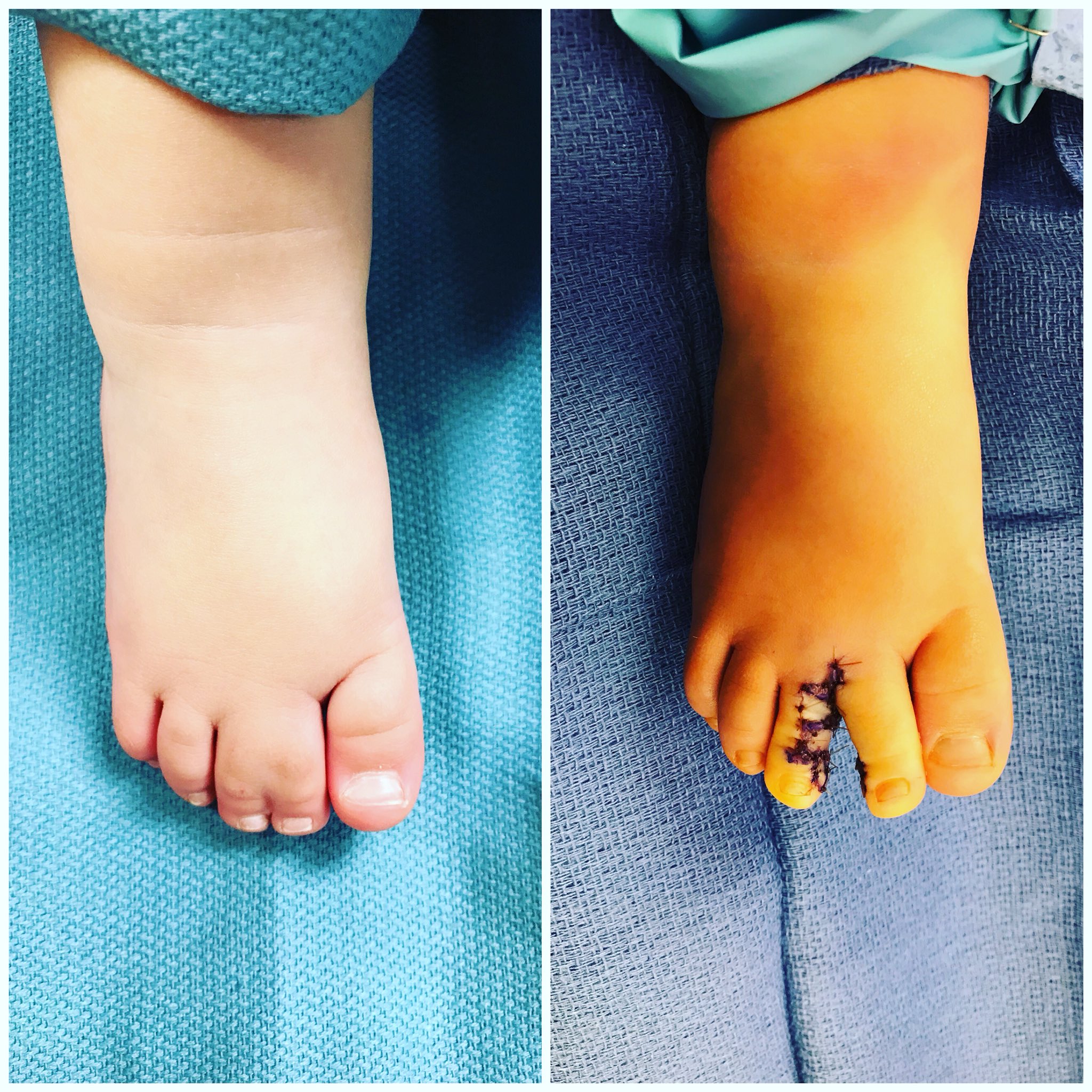 Webbed Toes Baby webbed-toes-baby