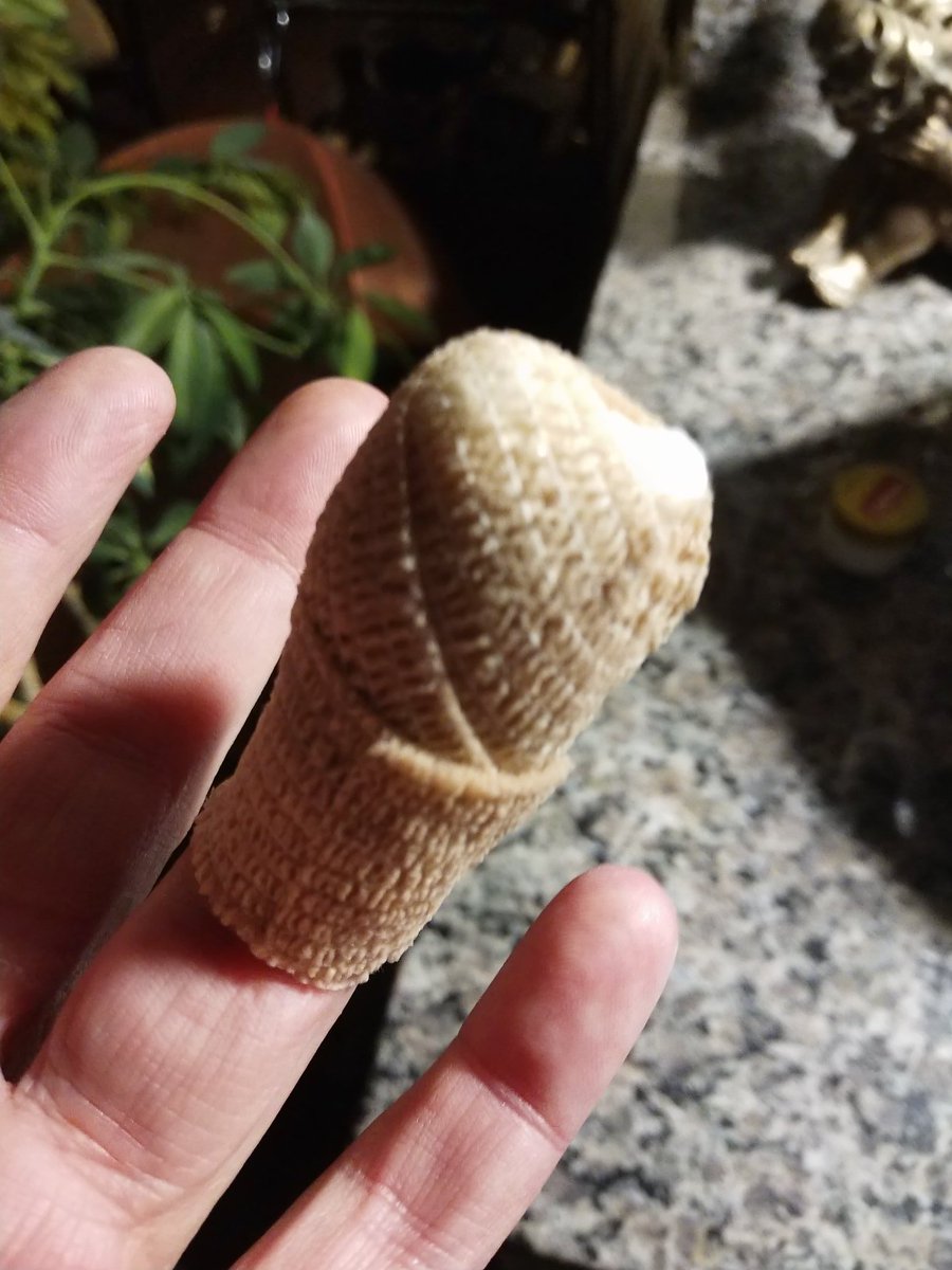 randomNRG's tweet photo. @RajBhardwajMD Can't believe after only a few weeks after Dr Raj gave advice on  @CBCEyeopener  regarding the use of (wire mesh) gloves when using the mandolin, I get glued back together by him! #safetyfirst #getthegloves https://t.co/sOQiGMNcJk