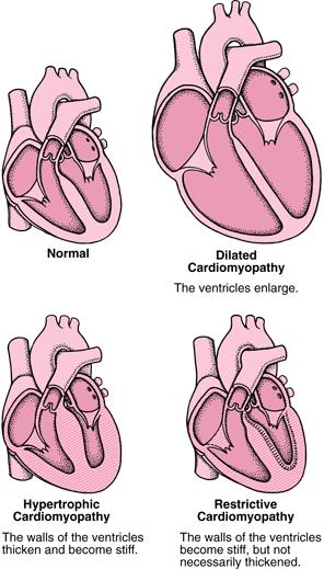 SEMDocs's tweet photo. Cardiomyopathy #medcomic #medbullets #sportsmedicine https://t.co/rMoMpuexYE